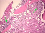 Follicular lymphoma-bone marrow biopsy - 1.