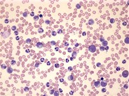 Chronic myelogenous leukemia, BCR-ABL1 positive