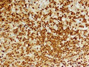 Marrow findings in JMML - 4.