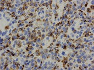 Marrow findings in JMML - 5.