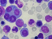 Four-nucleate plasma cell in multiple myeloma - 1.