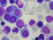 Four-nucleate plasma cell in multiple myeloma - 1.