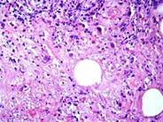Herpes simplex lymphadenitis - 2.