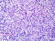 Herpes simplex lymphadenitis - 4.