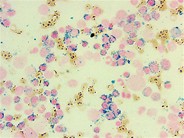 Refractory anemia with ringed sideroblasts and thrombocytosis (RARS-T) - Prussian blue iron stain - 1.