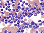 Increased M:E ratio - 2.