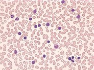 Adult T-cell leukemia / lymphoma