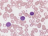 Marginal zone lymphoma: leukemic phase - 3.
