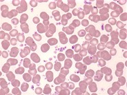 Essential-thrombocythemia-peripheral-smear--2