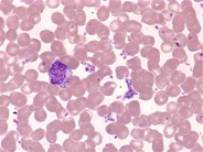 Essential-thrombocythemia-peripheral-smear--4