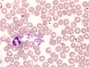 Essential-thrombocythemia-peripheral-smear--5