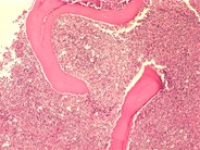 AML with maturation - 6.