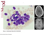 CNS hyperleukocytosis