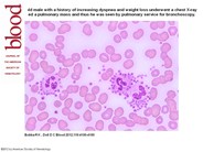 Platelet satellitism as a cause of spurious