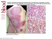 Myelosarcoma in Fanconi anemia