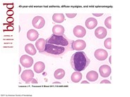 Persistent polyclonal B-cell lymphocytosis