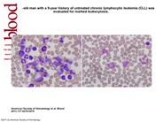 Simultaneous chronic myeloid leukemia and chronic lymphocytic leukemia
