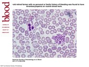 Pseudothrombocytopenia