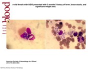 Peripheral smear discloses histoplasmosis