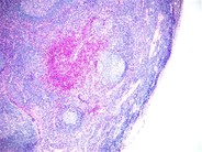 Kimura lymphadenopathy - 1.