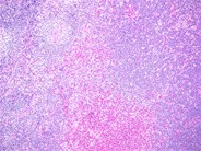 Kimura lymphadenopathy - 2.