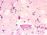 Amyloidosis: Acquired Factor X Deficiency - 5.