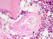 Amyloidosis: Acquired Factor X Deficiency - 8.