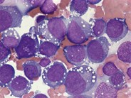 Pure erythroid leukemia