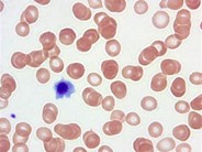 HIV-Related Thrombocytopenia - 1.