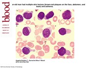 Blastic plasmacytoid dendritic cell neoplasm