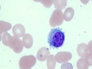 Hairy Cell Leukemia