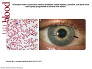 Fulminant Wilson disease
