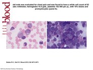 Promyelocytic blast crisis of chronic myelogenous leukemia