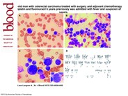 Myelodyspastic syndrome with complex cytogenetics