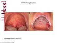 cGVHD affecting the palate