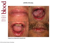 cGVHD of the lips