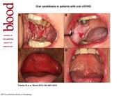 Oral candidiasis in patients with oral cGVHD