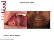 Orofacial sclerotic cGVHD
