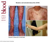 Morphea- and sclerodermatous-like cGVHD