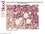 AML in Gaucher disease