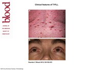 Clinical features of T-PLL