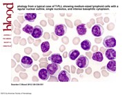 PB morphology from a typical case of T-PLL