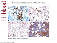 BM intrasinusoidal infiltration pattern in different splenic lymphoma entities