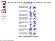 Morphologic clues of splenic lymphoma neoplastic cells in the PB