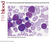 Transient myeloproliferative disorder