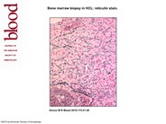 Bone marrow biopsy in HCL: reticulin stain