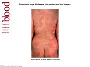 Mycosis Fungoides with patches and thin plaques
