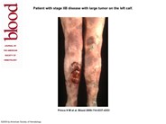 Stage IIB MF with large tumor on the left calf