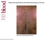 Mycosis Fungoides with folliculotropic plaques on the trunk.