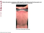 Mycosis fungoides (stage IB) on the limbs and self-healing papules and nodules of lymphomatoid papulosis on the trunk
